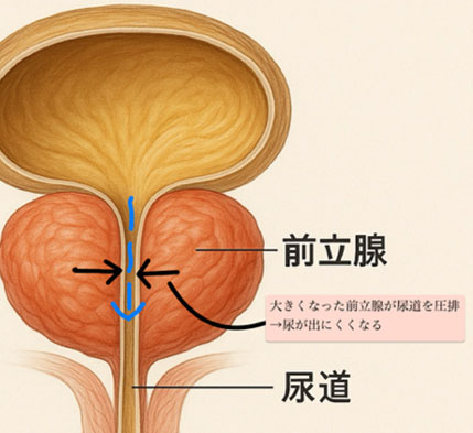 前立腺肥大症